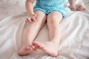 bed bug bits on child's legs