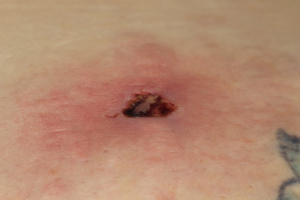 Close up of a brown recluse bite