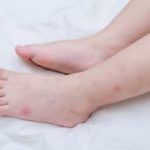 Bed bug bites on a toddler's feet and ankles