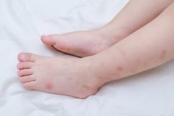What do bed bug bites look like on a toddler's feet and ankles? - Griffin Pest Solutions in Kalamazoo Michigan