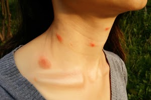 Bed bug bites on a woman's neck