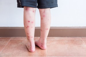 Lines of bed bugs on a toddler's legs