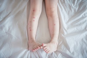 What do bed bug bites look like on legs? - Griffin Pest Solutions in Kalamazoo MI