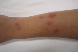 What do bed bugs look like on arms? - Griffin Pest Solutions in Kalamazoo MI